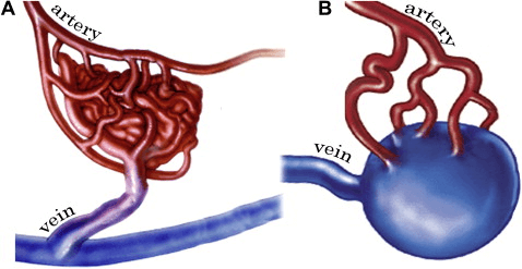 Δύο τύποι αρτηριοφλεβώδων δυπλασιών του εγκεφάλου