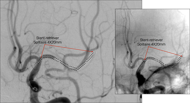 Stent Retriever