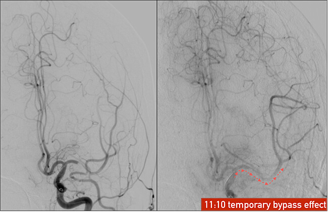 Stent Retriever