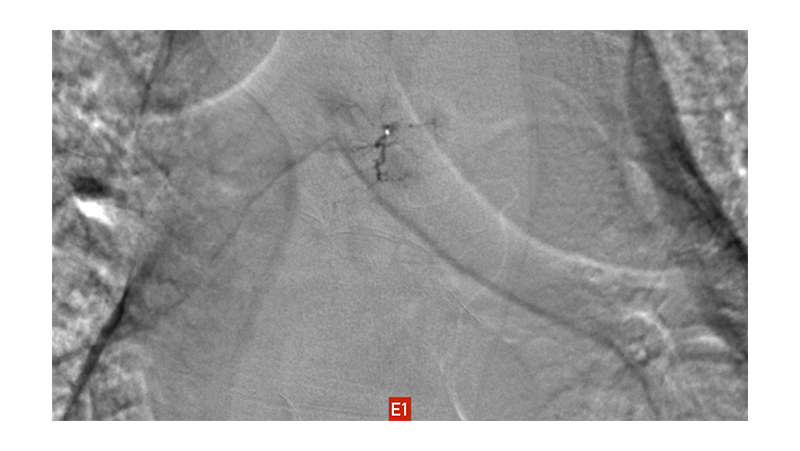 peristatiko plasmatokuttwmatos spondulikhs sthlhs.006